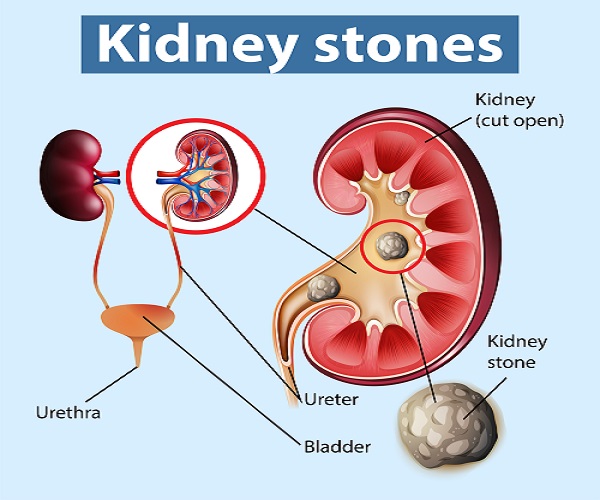 what-is-Kidney-stone_Mantra_Care